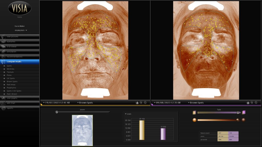 Sun spots, brown spots, liver spots