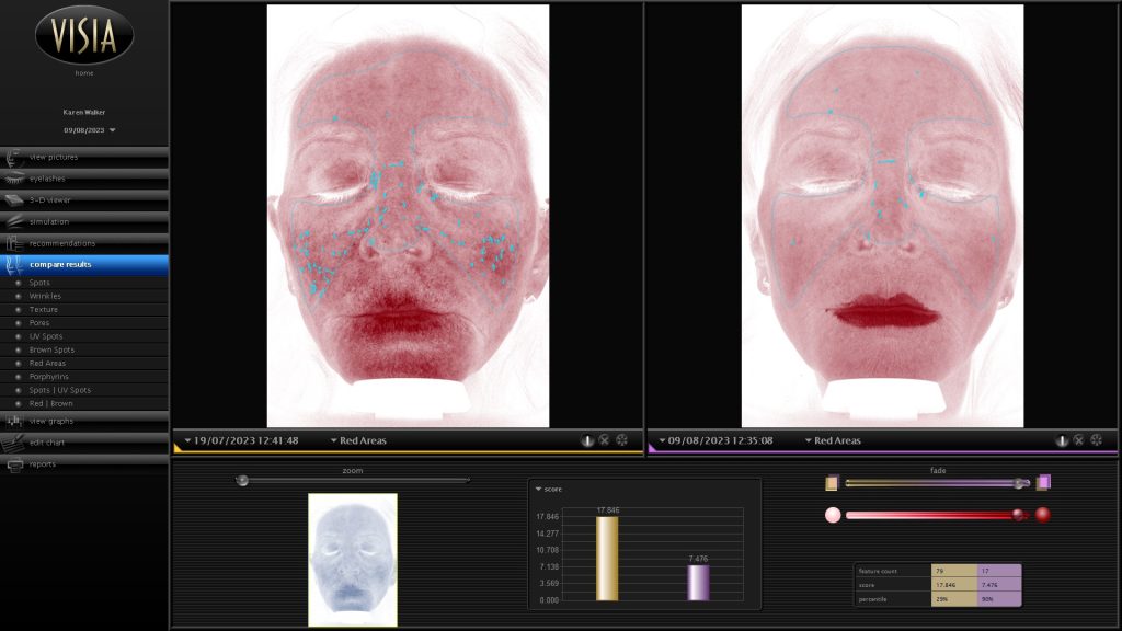 Red spots facial