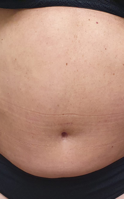 aqualyx-treatment-before