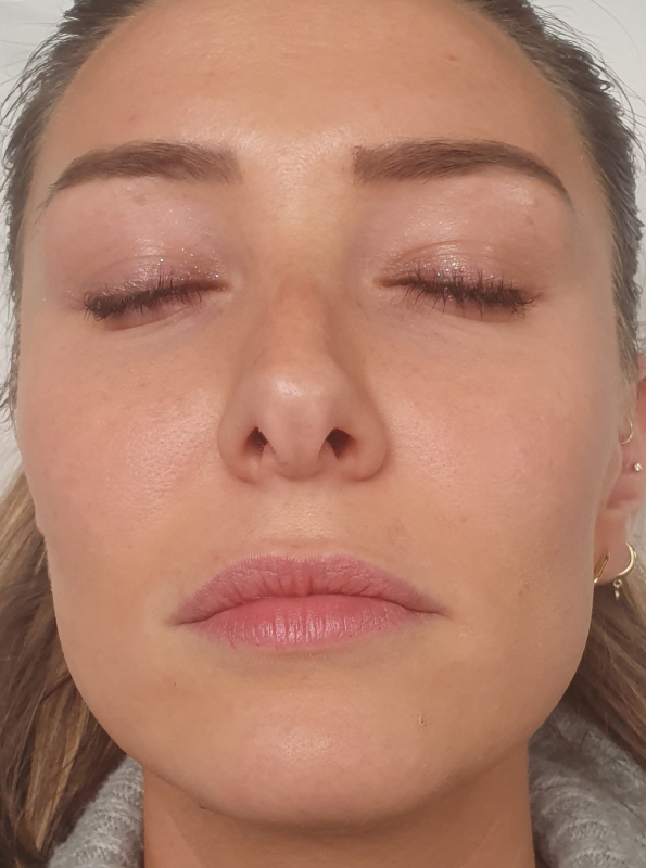 dermal-filler-before