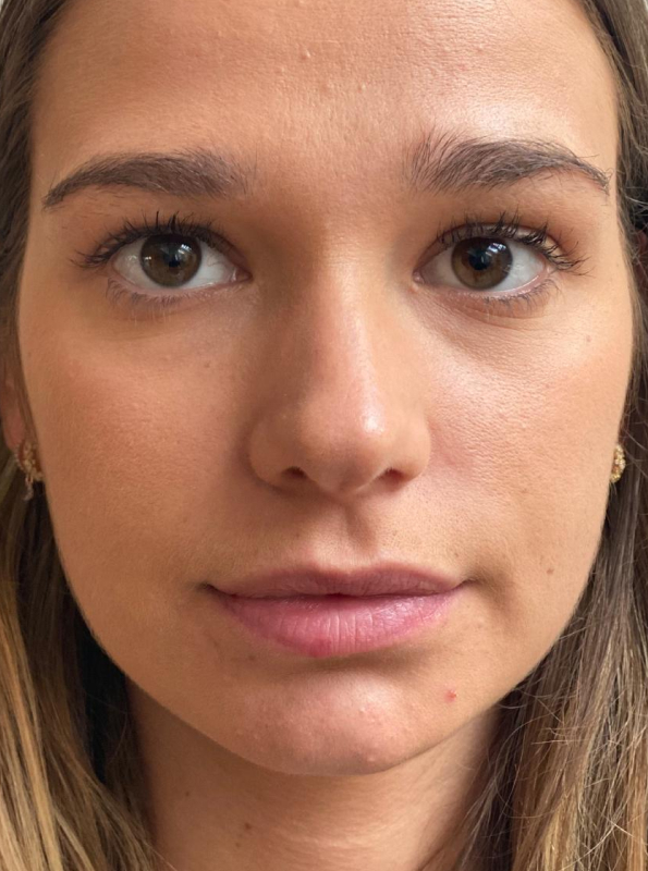 dermal-filler-facial-before