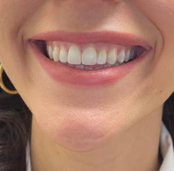 gummy-smile-botox-before