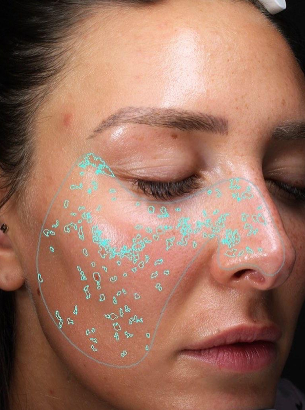 illuminator-facial-cheeks-before