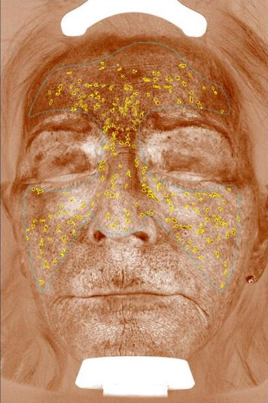 rejuvenator-facial-brown-spots-before