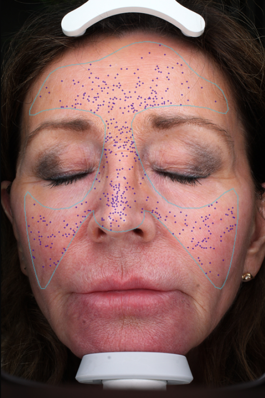 rejuvenator-facial-pores-before