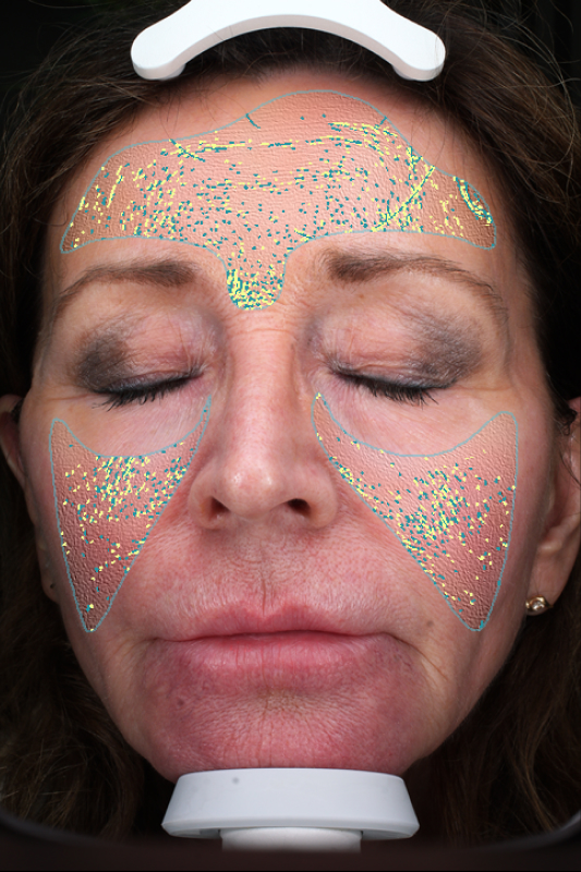 rejuvenator-facial-texture-before