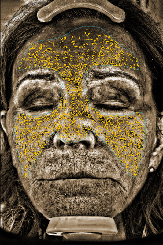 rejuvenator-facial-uv-spots-before