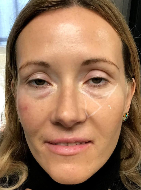 tear-trough-filler-before
