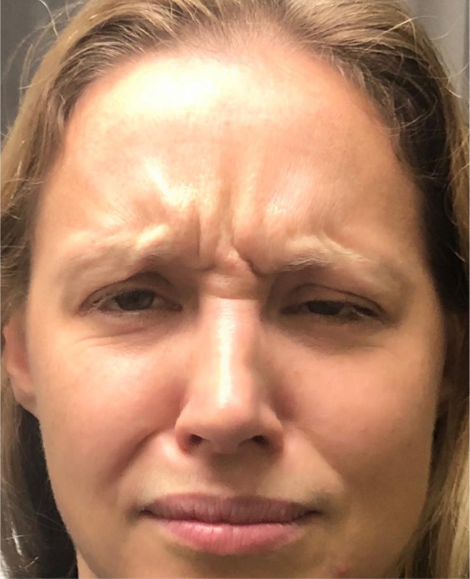 Botox-Before-2