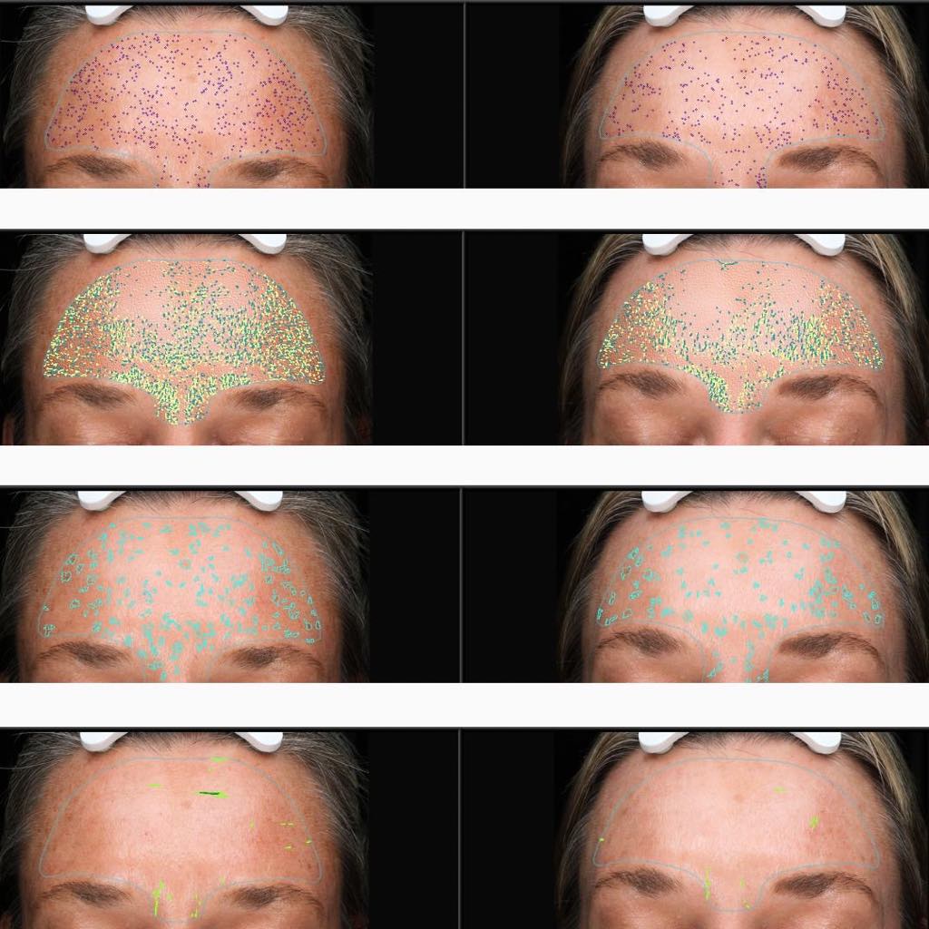 Visia images of skin resurfacing before and after