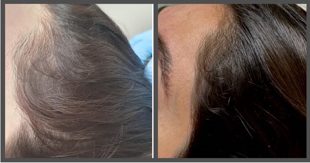 PRP treatment at the Prager Clinic for hair loss